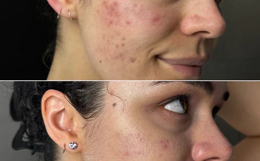 Rotlichttherapie Vorher & Nachher: Bilder und Ergebnisse